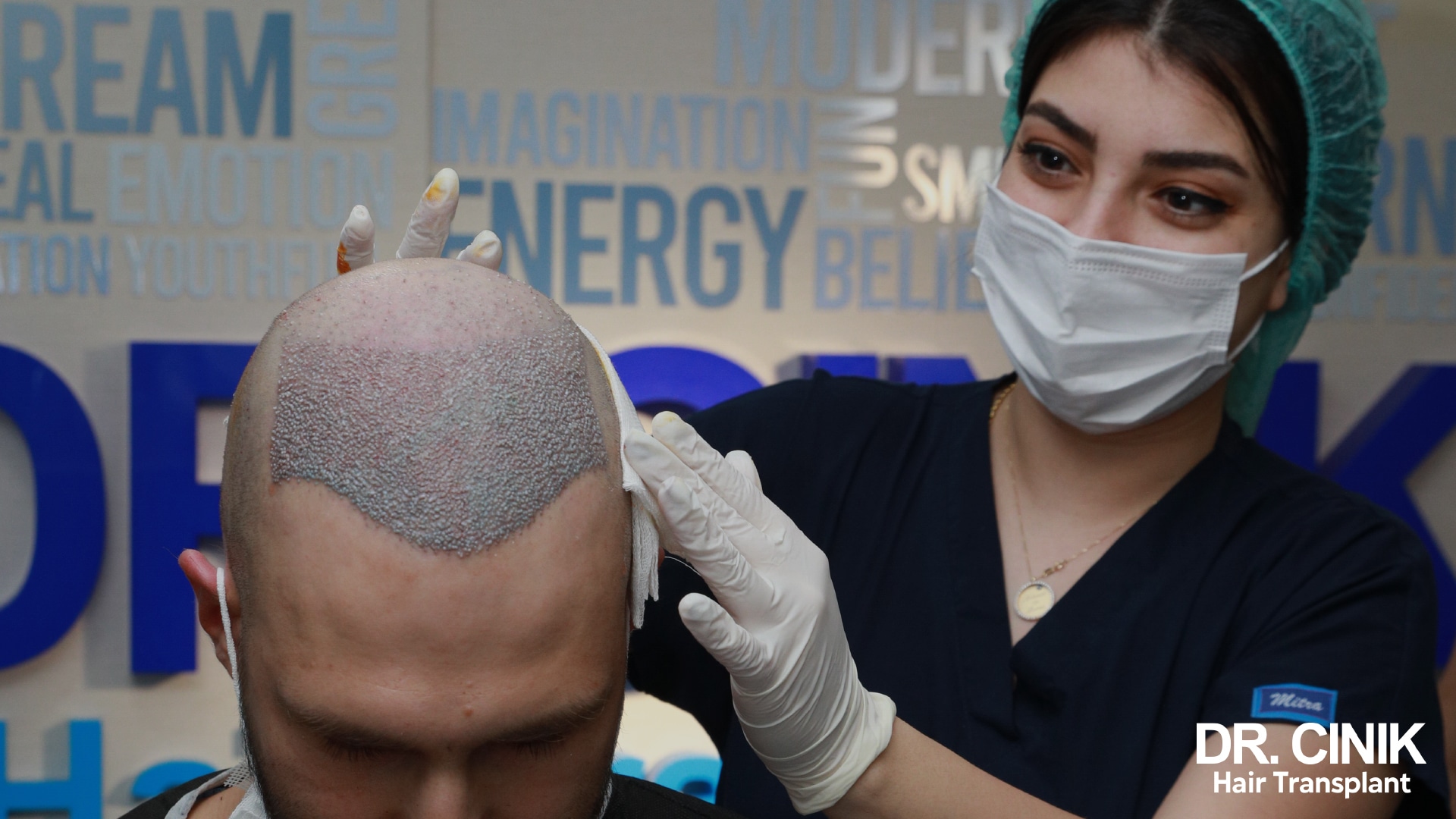 Techniques de greffe de cheveux L essentiel à savoir pour faire le