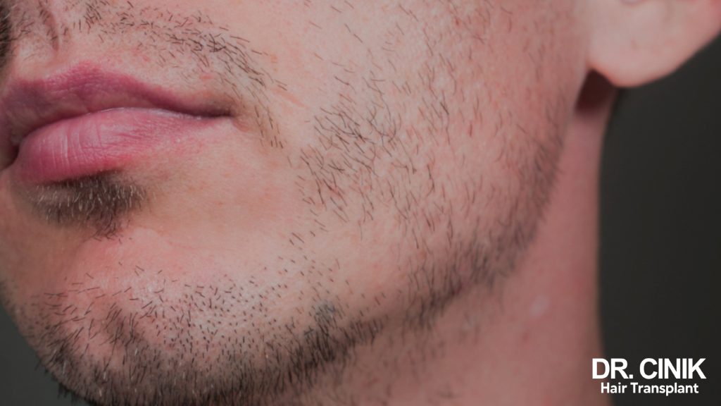 Barbe clairsemée : causes et solutions pour densifier sa barbe