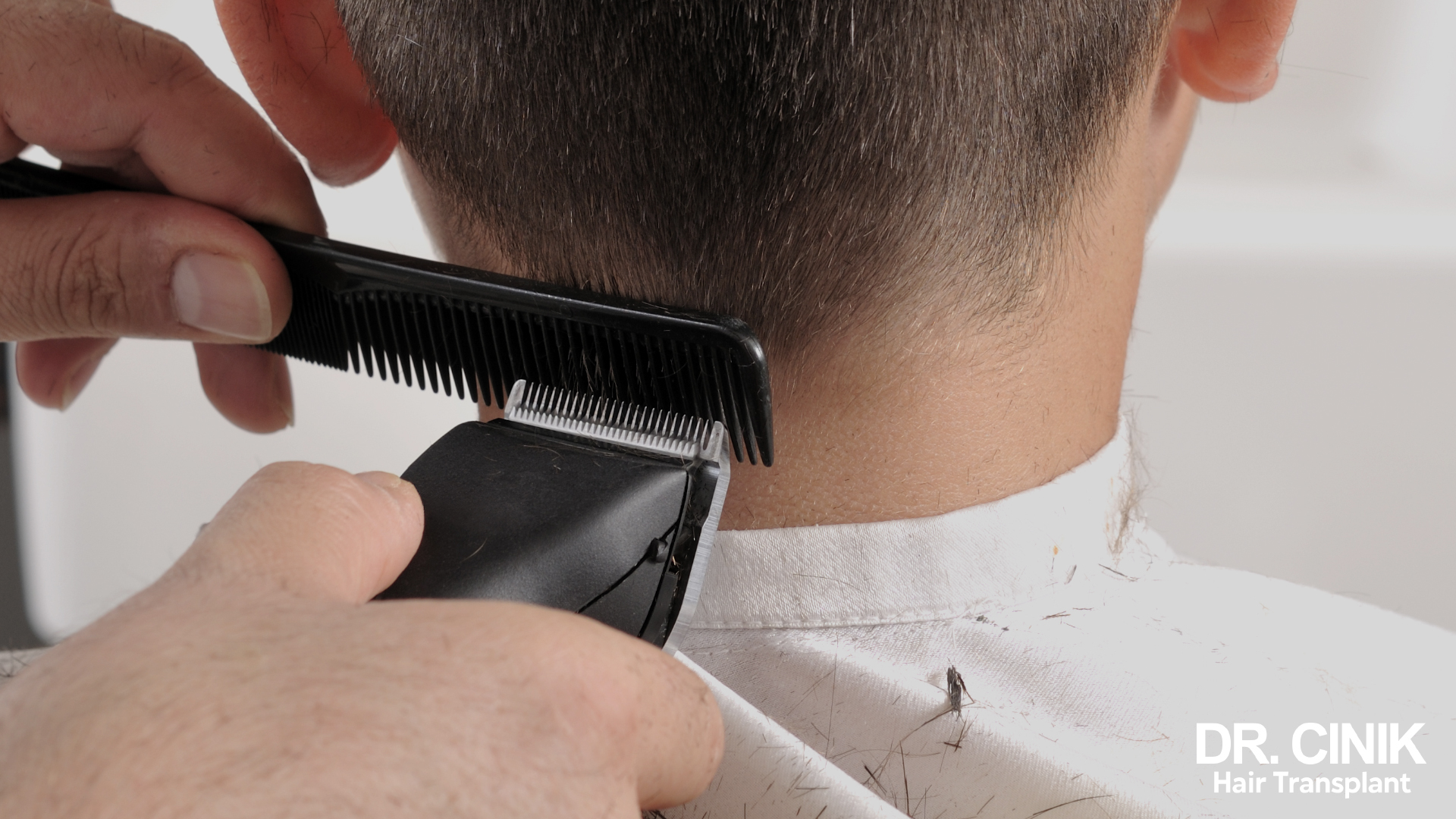 Consejos para cortar el pelo después de un injerto capilar