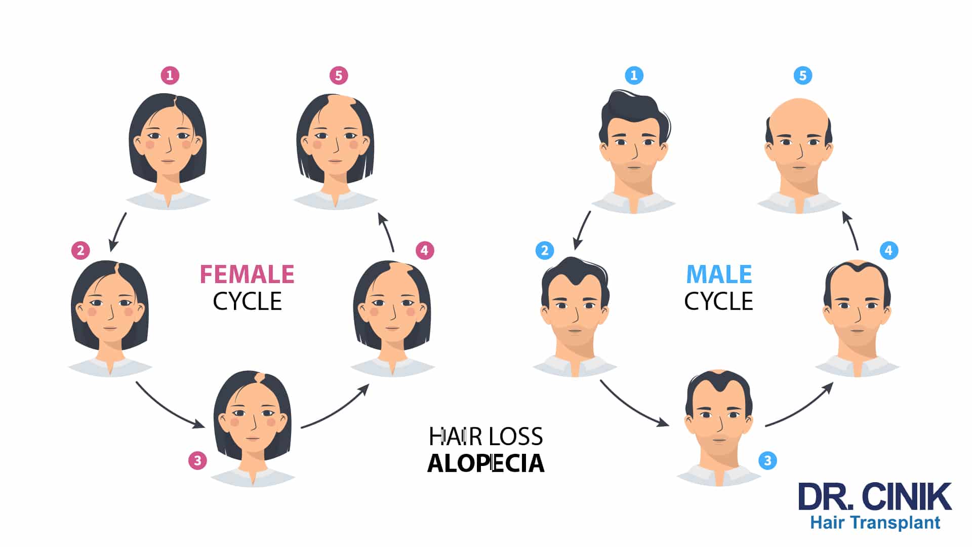Dr Cinik infographic comparing the female cycle and the male cycle of hair loss in five stages, from a full head of hair to established baldness, labelled female cycle, male cycle and hair loss alopecia