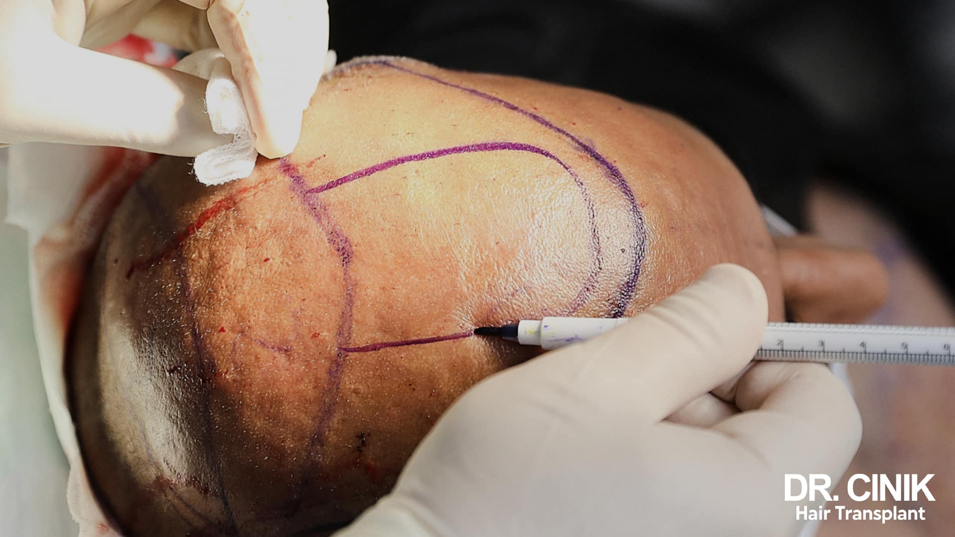 Testa diradata su cui un operatore guantato traccia con un pennarello viola il contorno della zona da trapiantare, con un righello graduato appoggiato di fianco
