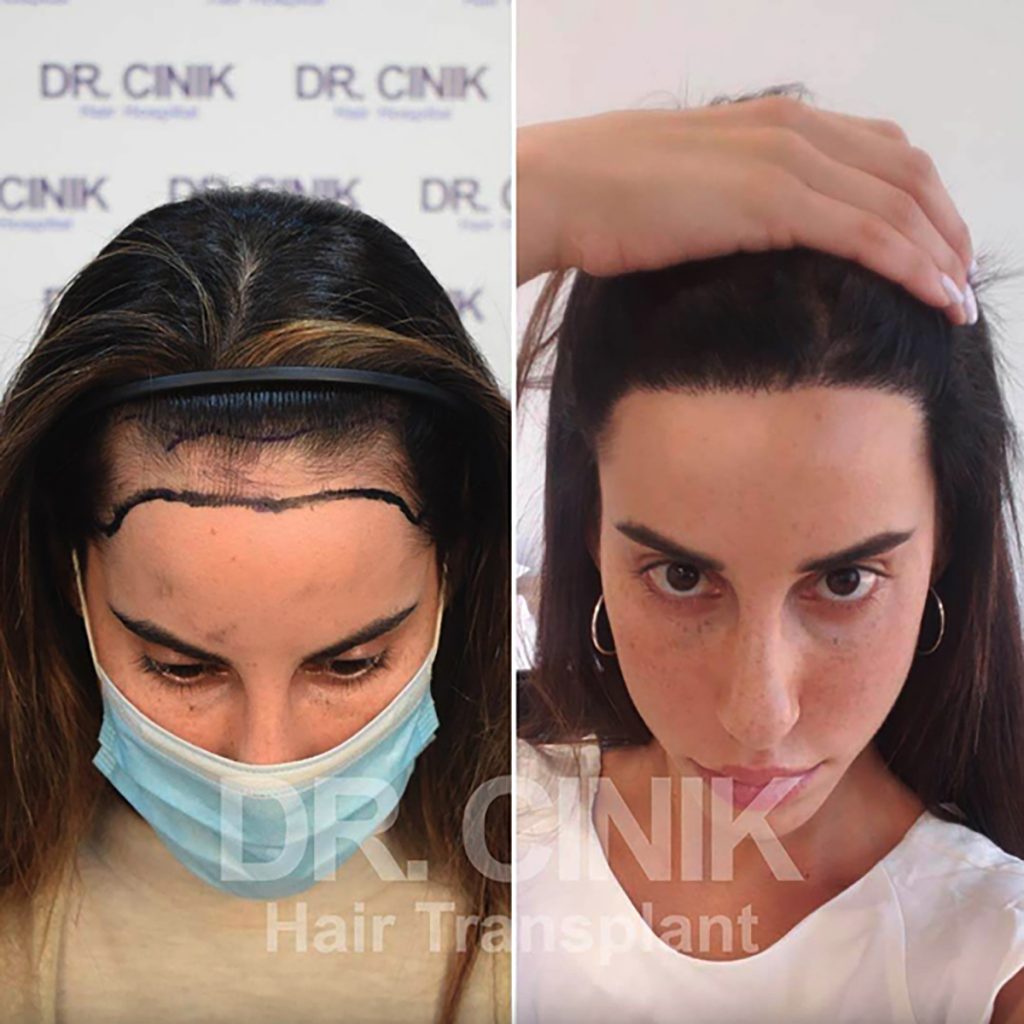 Haartransplantation für Frauen vorher nachher | Dr. Cinik