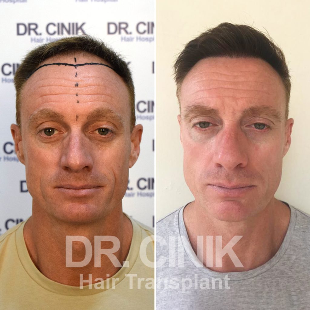 Witness Remarkable Hair Transplant Results: Before and After