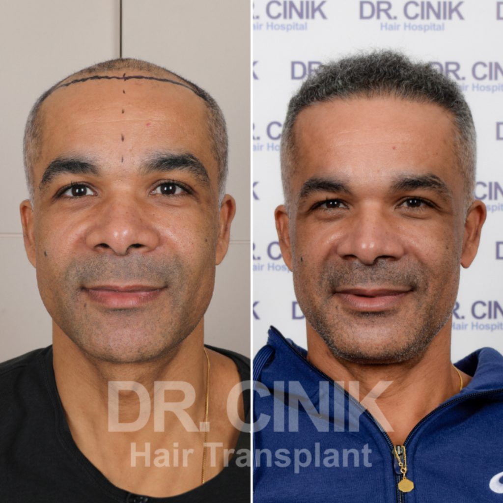 Witness Remarkable Hair Transplant Results: Before and After