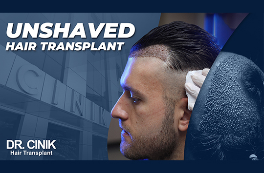 NYC Hair Transplant Photo Gallery Before and After Pictures - New York - UES