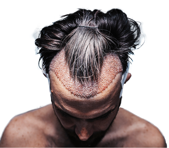 What Are the Disadvantages of Hair Transplant