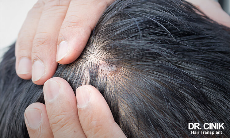 Acne also causes scabs on the scalp