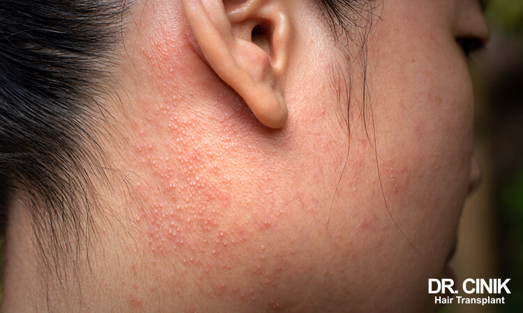 Contact Dermatitis is one of the causes of scalp scabs