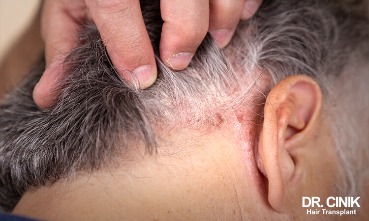 Scalp Psoriasis is another cause of scabs on the scalp