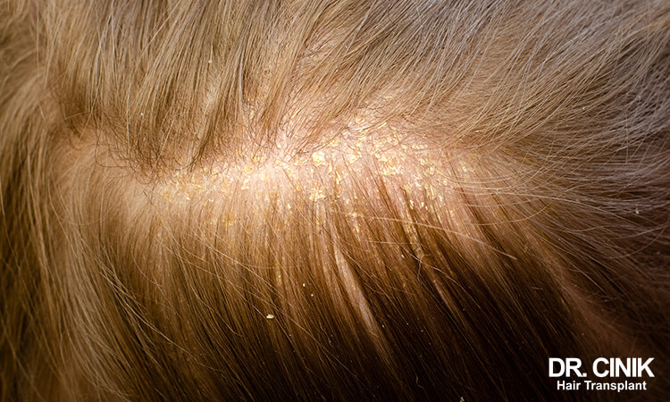 Seborrheic Dermatitis causes scabs on scalp