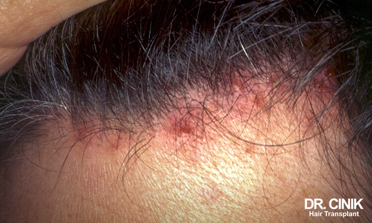 Shingles causes scabs on the scalp