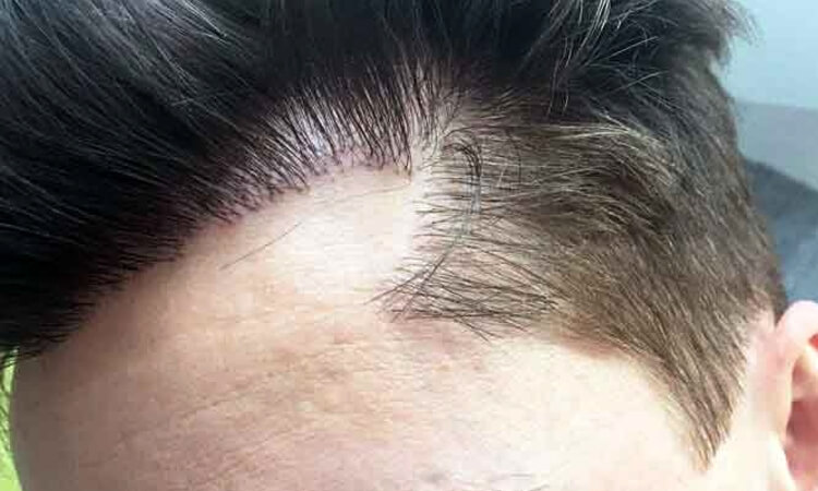 unnatural hair direction in a failed hair transplant