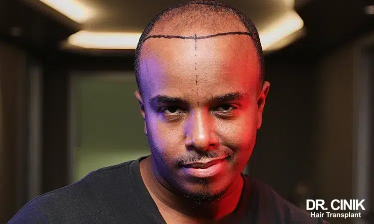 afro hair transplant patient is happy