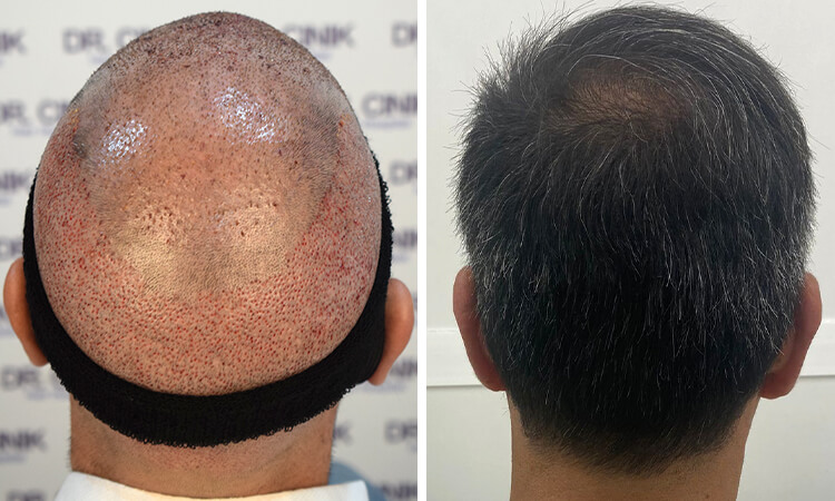 a man's donor is healed after a successful hair transplant