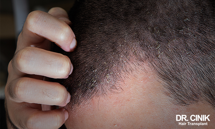 Eczema is another cause of scabs on the scalp