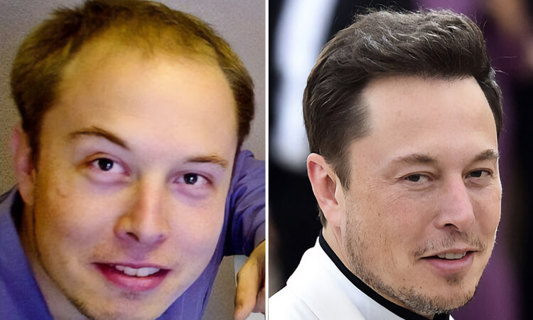 Elon Must Hair Transplant