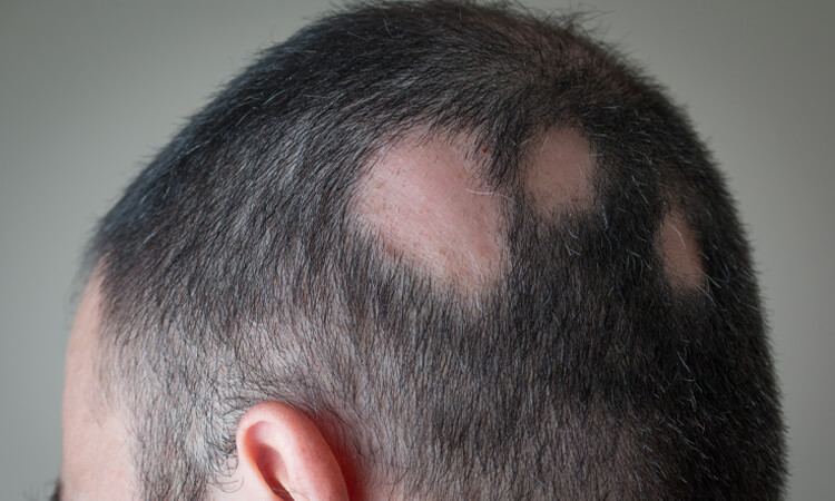 A man experiencing patchy hair loss due to alopecia