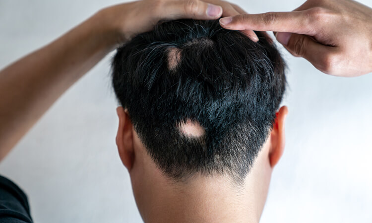 A man is showing his nape after alopecia hair loss in patches