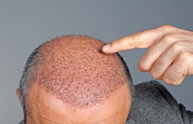Shedding after Hair Transplant: It is normal? - Regrow Hair Clinic