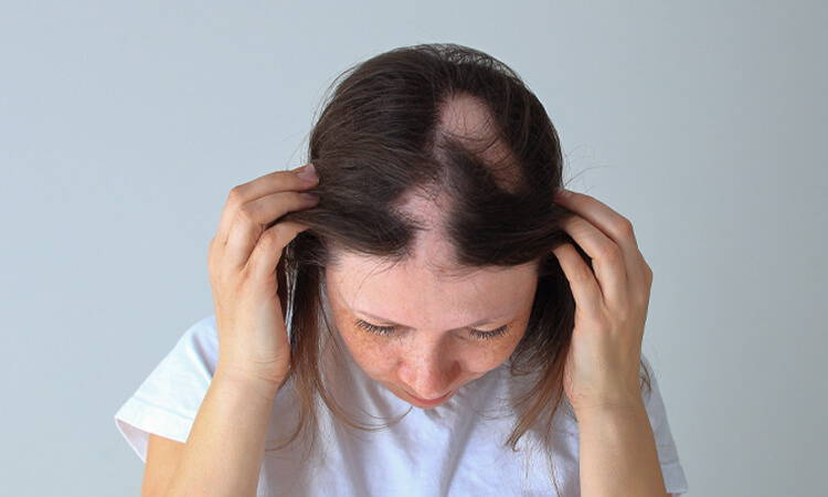a middle-aged woman is checking her patchy hair loss after alopecia