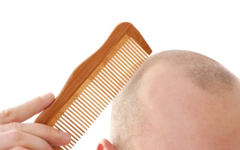 טיפול בנשירת שיער חמורה