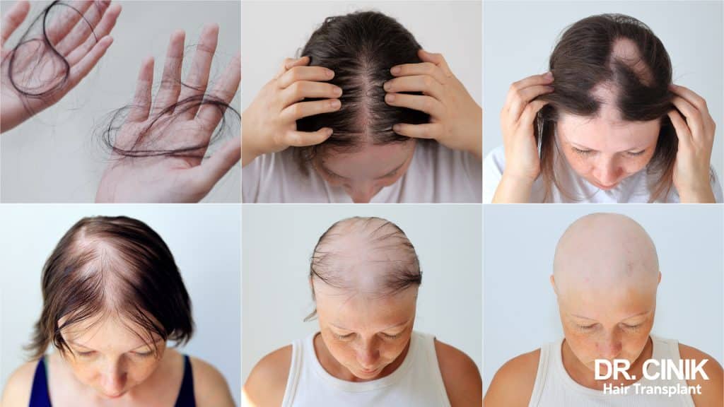 Female Pattern Hair Loss: A Lady's Guide To Maintaining A Luscious Mane