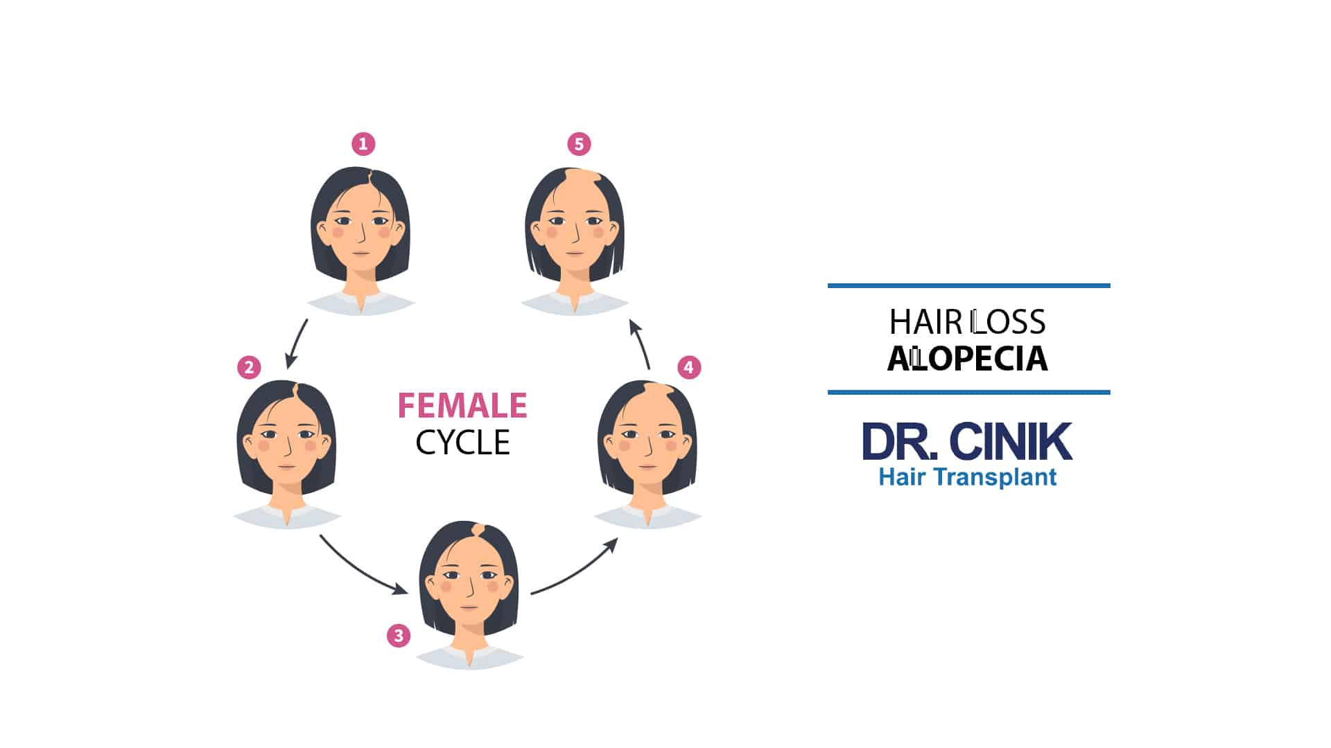 Female Pattern Baldness Cycle