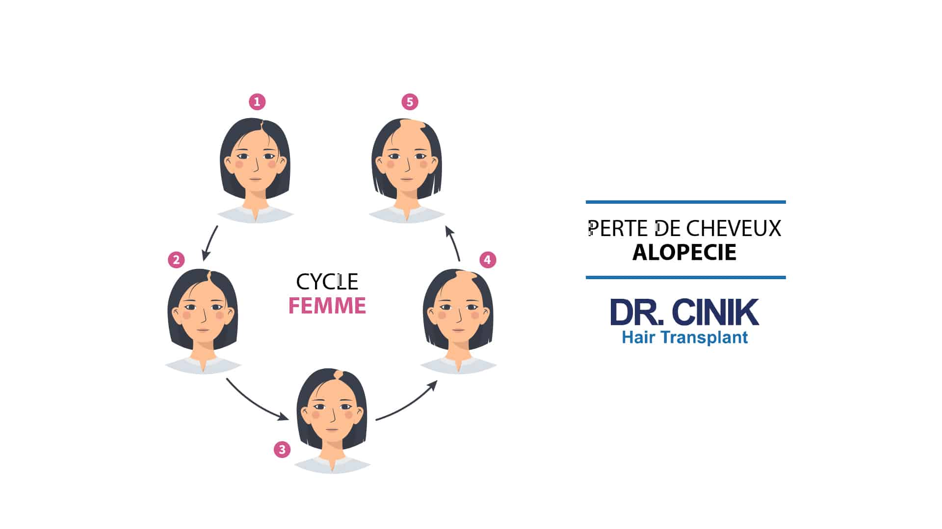 L'évolution de l'alopécie androgéntique chez les femmes
