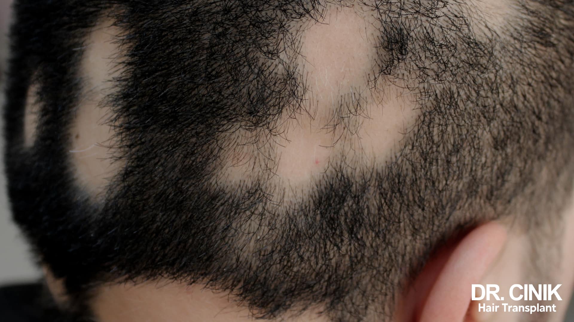 Alopecia Areata, a type of patchy hair loss