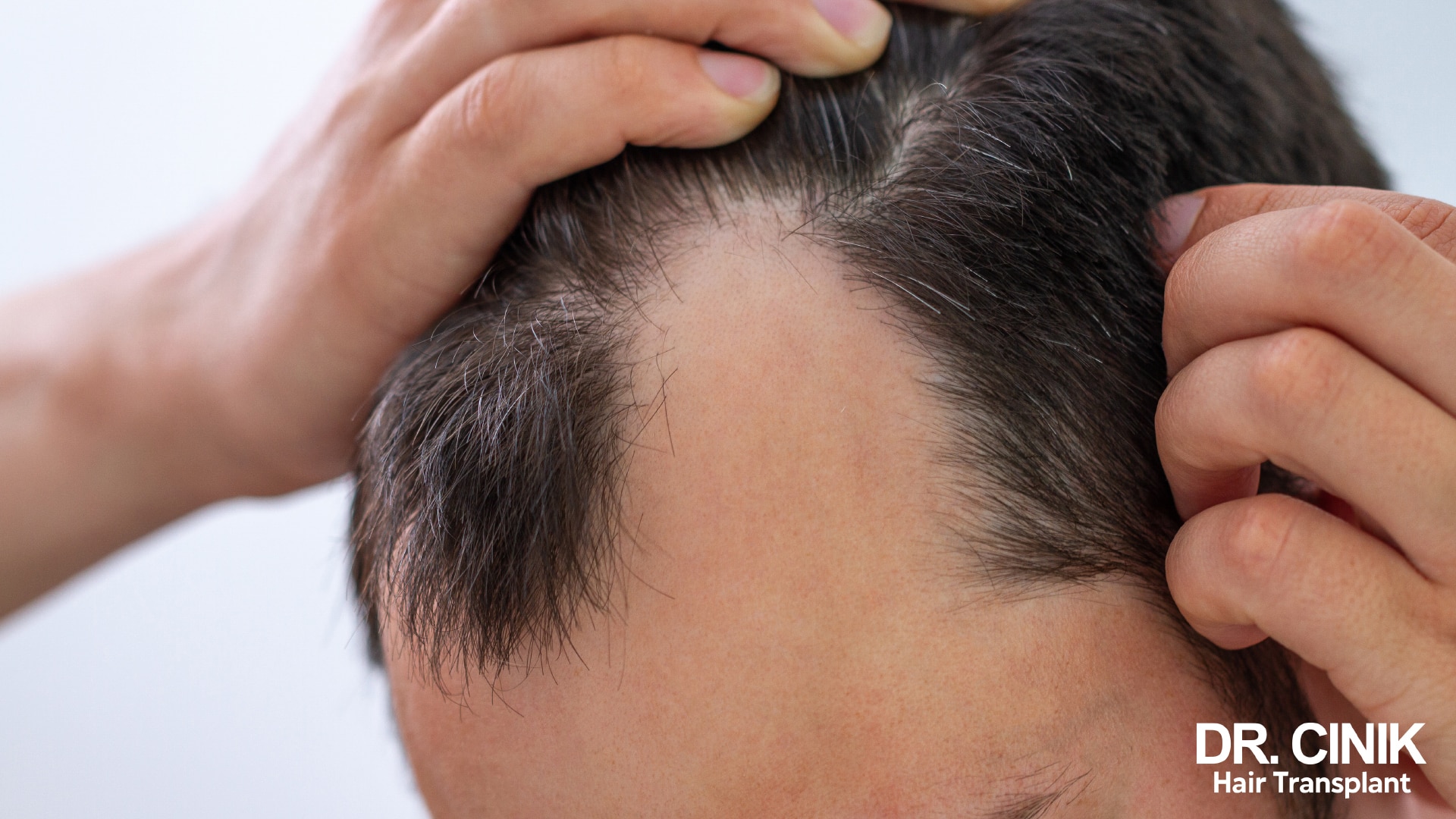 An onset of androgenetic alopecia.