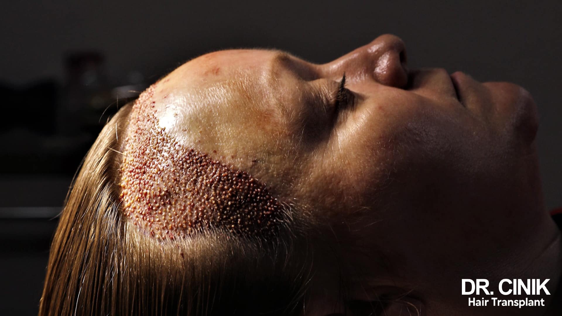 Une femme est en plein processus de greffe de cheveux via la méthode DHI, qui nécessite un rasage partiel du cuir chevelu. Elle se trouve actuellement dans la phase d'implantation des follicules capillaires