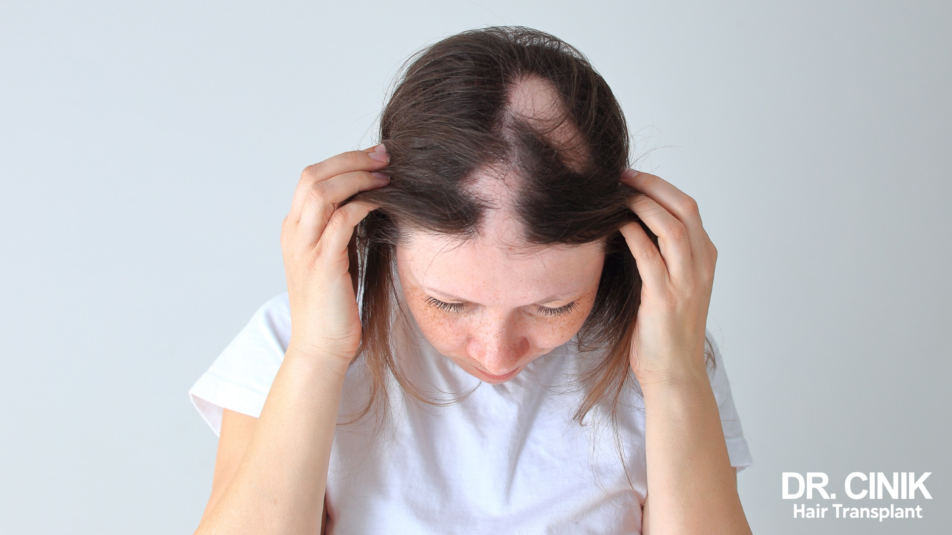 An advanced stage of androgenetic alopecia in women.