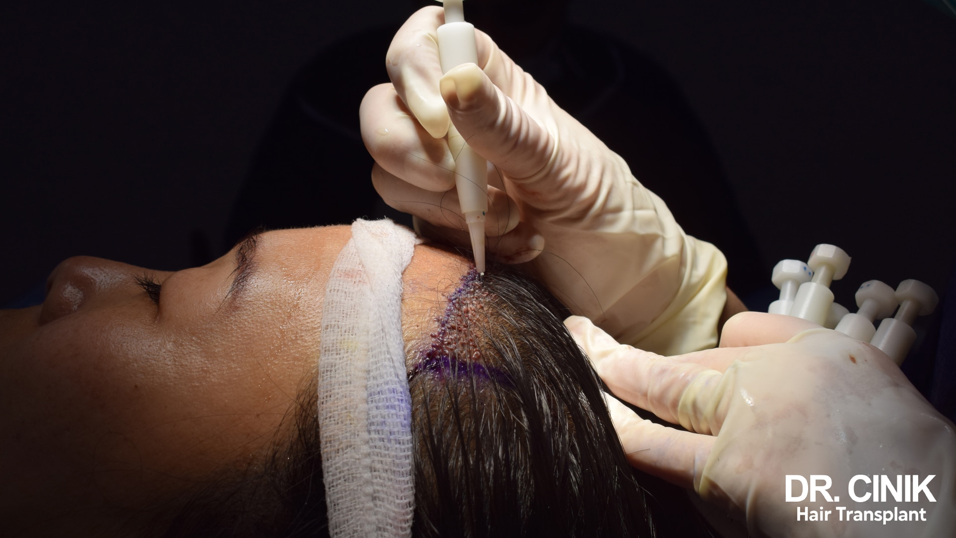 A woman is in the process of receiving a Direct Hair Implantation (DHI) transplant, which involves partial shaving, currently at the stage of hair follicle implantation