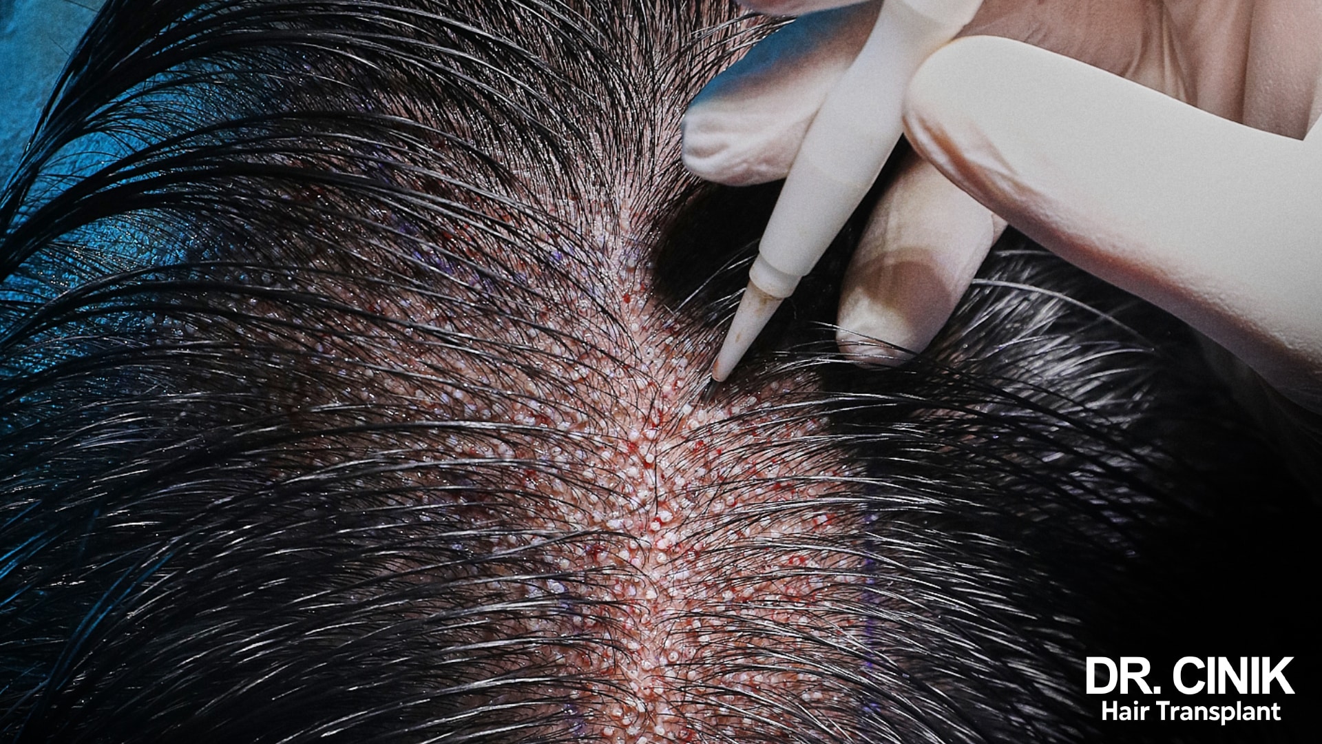 DHI hair transplant, a possible treatment for female hair pattern baldness