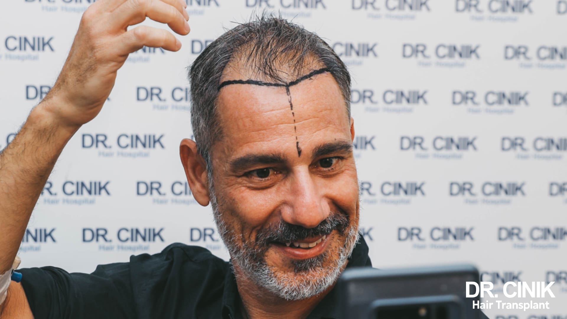 Un patient du Dr Cinik après une greffe de cheveux
