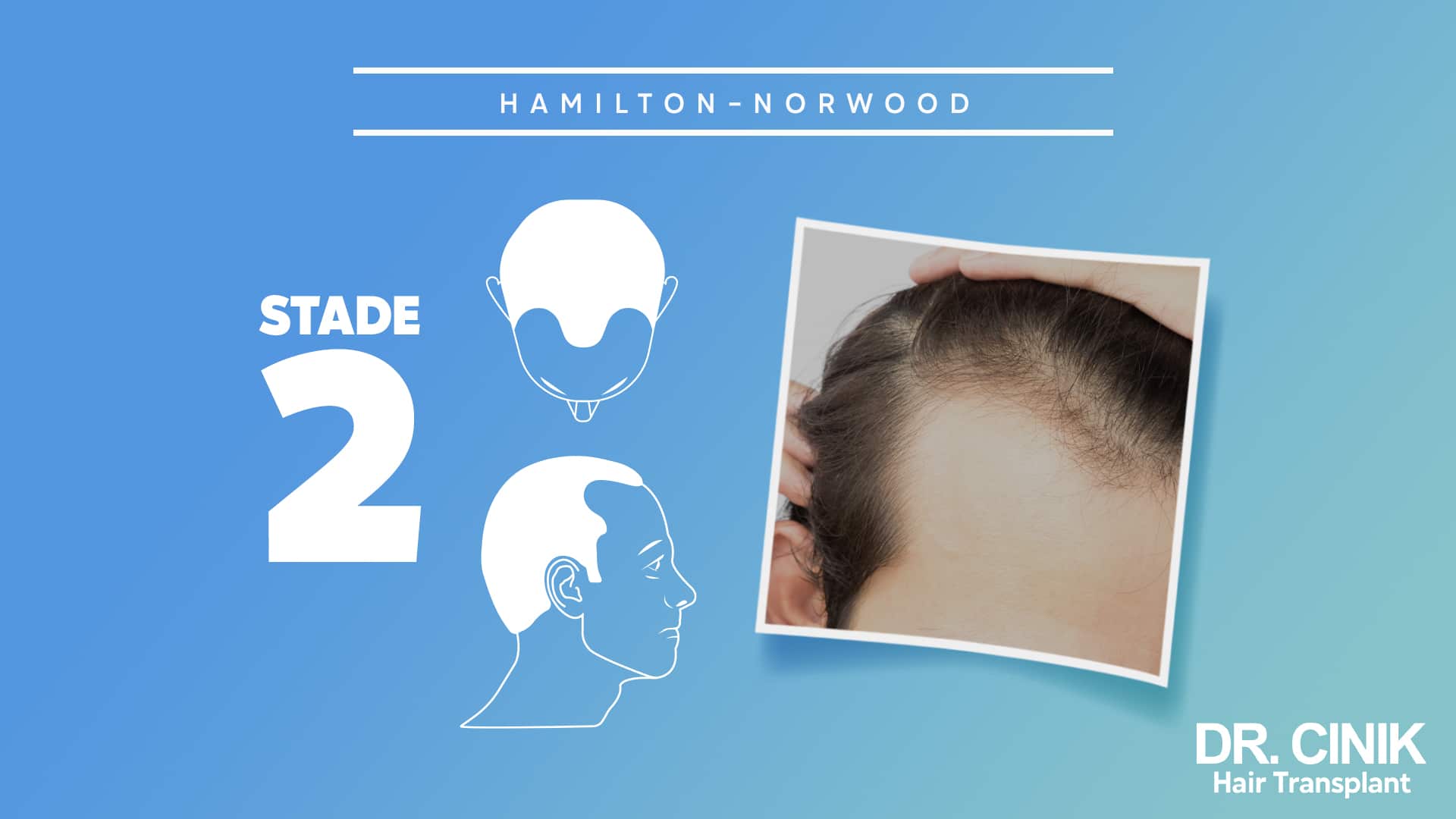 Stage 2 of the Norwood Hamilton scale.