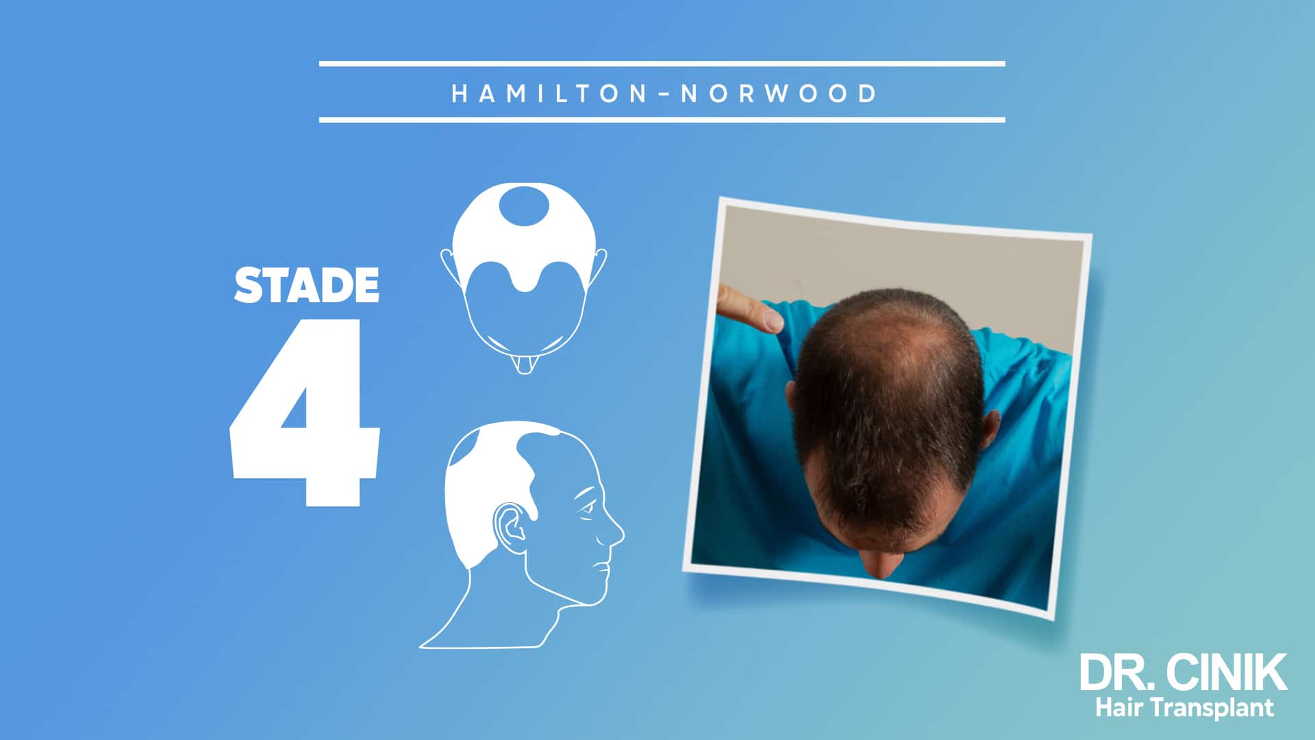 Stage 4 of the Norwood Hamilton scale.