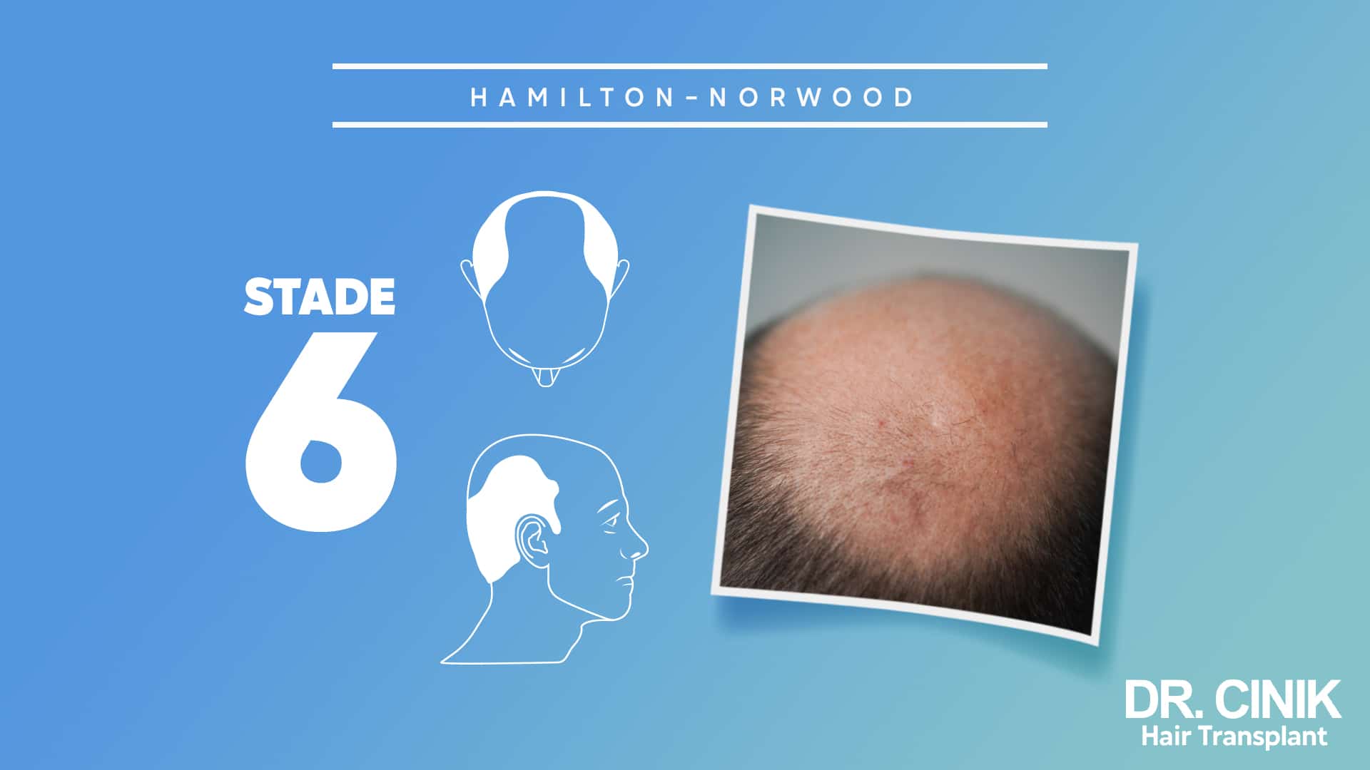 Stage 6 of the Norwood Hamilton scale.