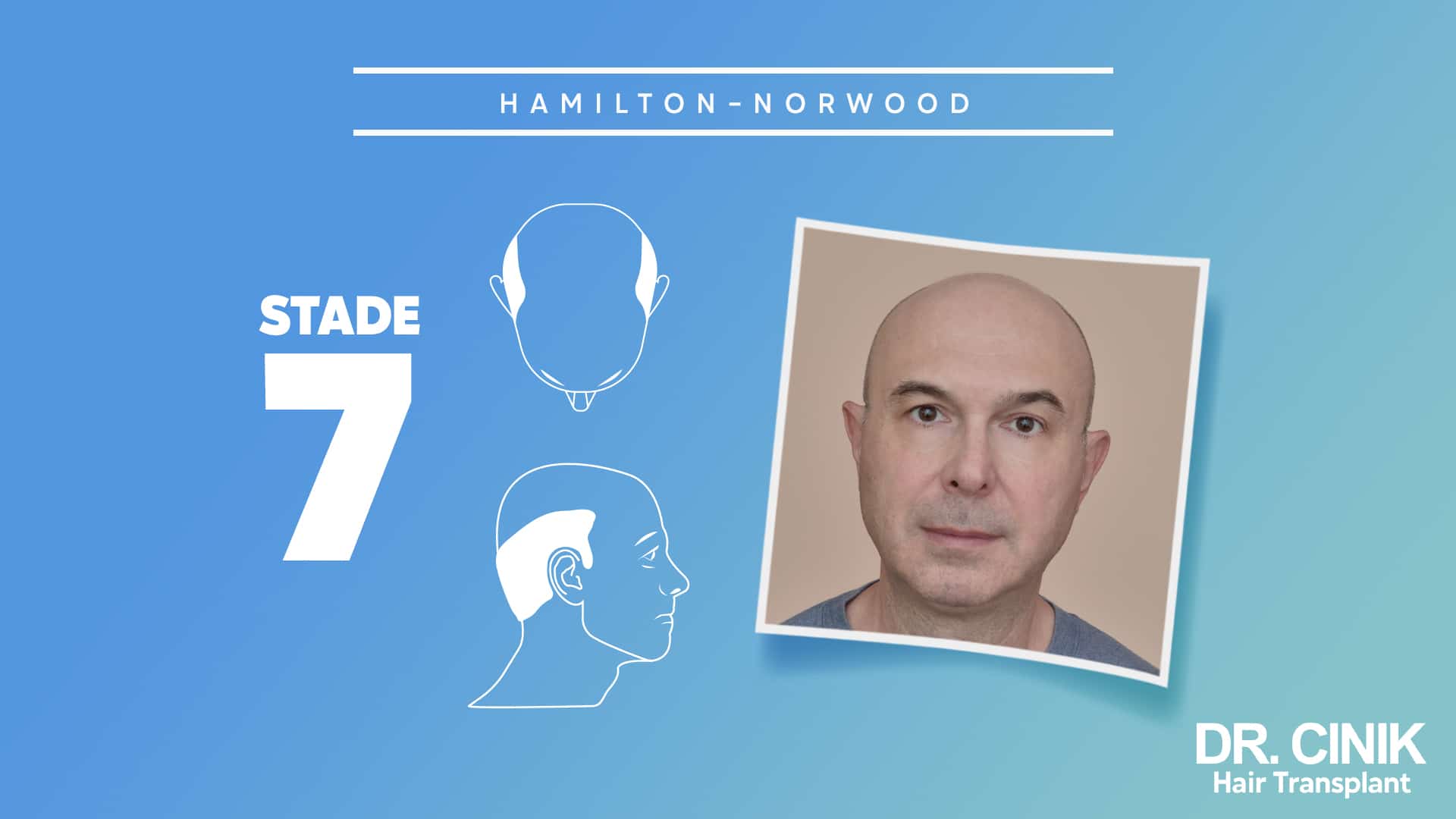 Stage 7 of the Norwood Hamilton scale.