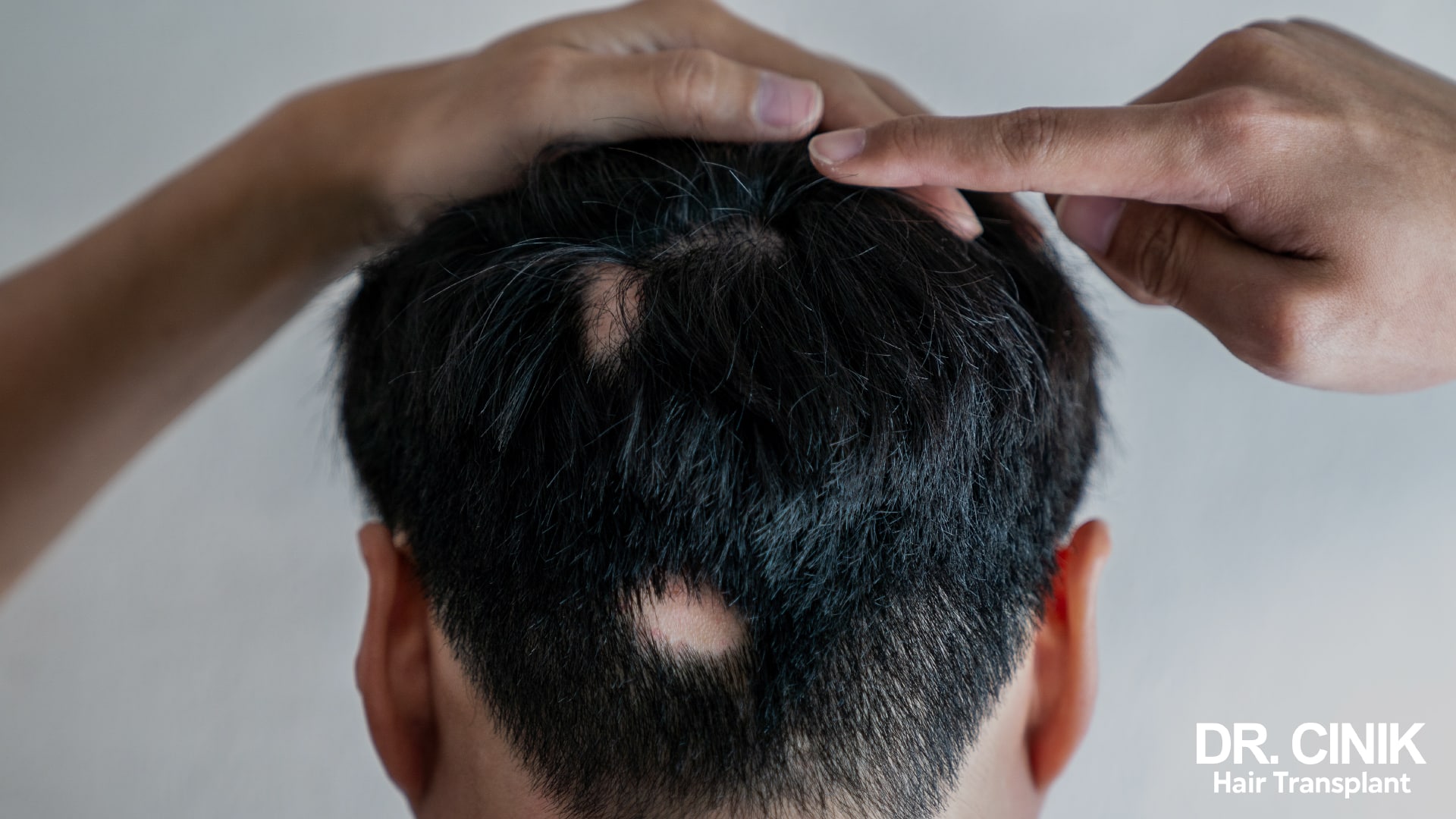 Pelade ou Alopecia Areata : une maladie auto immune méconnue | Dr ...