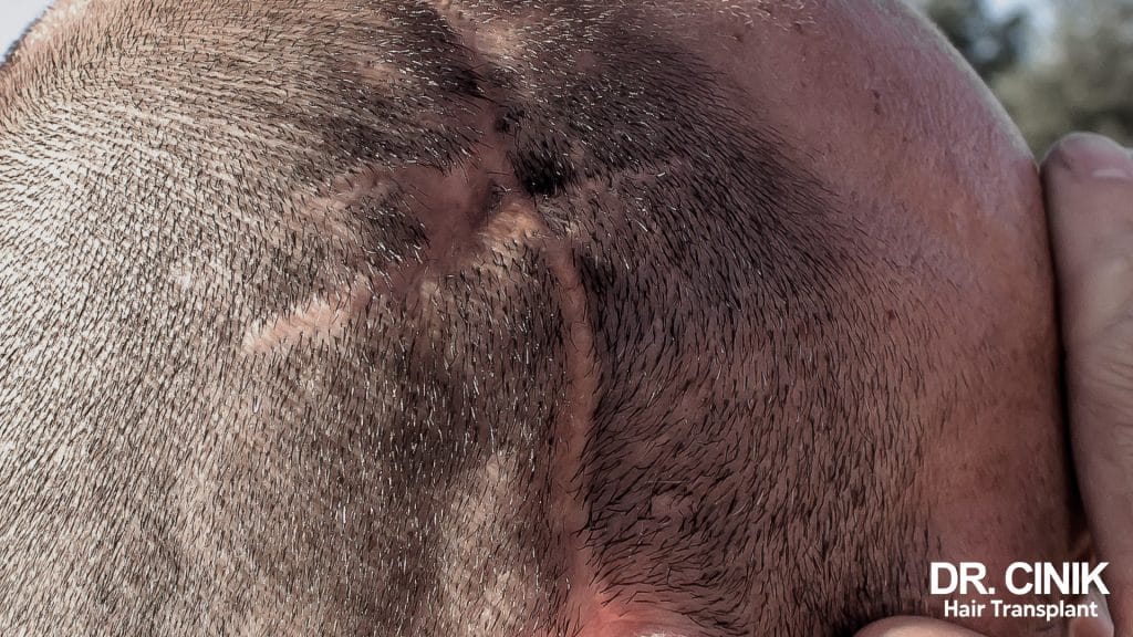 An example of scarring alopecia