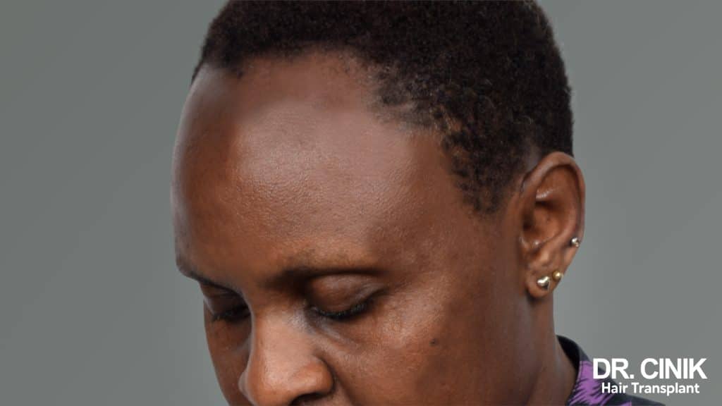 A person with traction alopecia