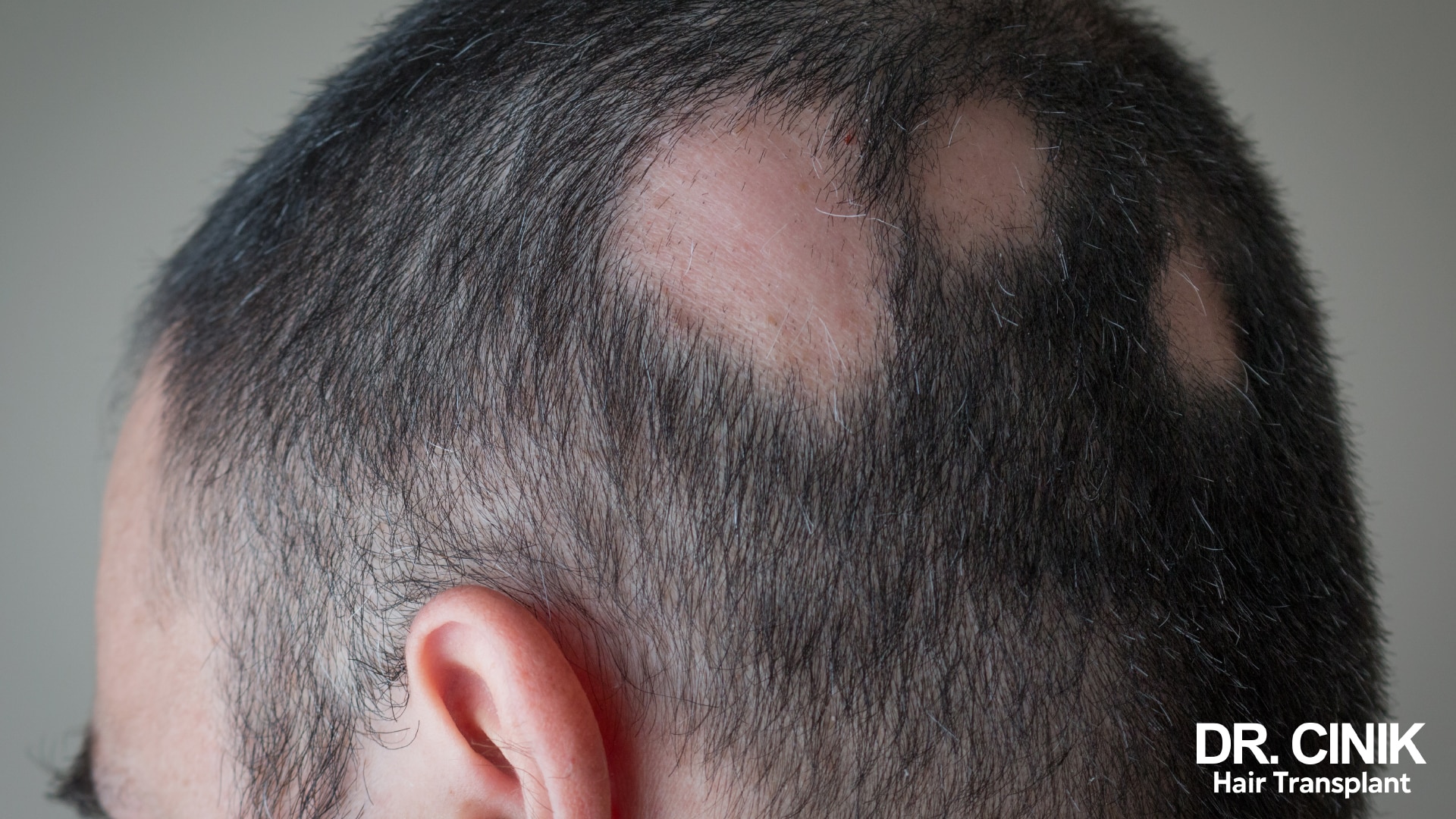 A men having patchy hair loss