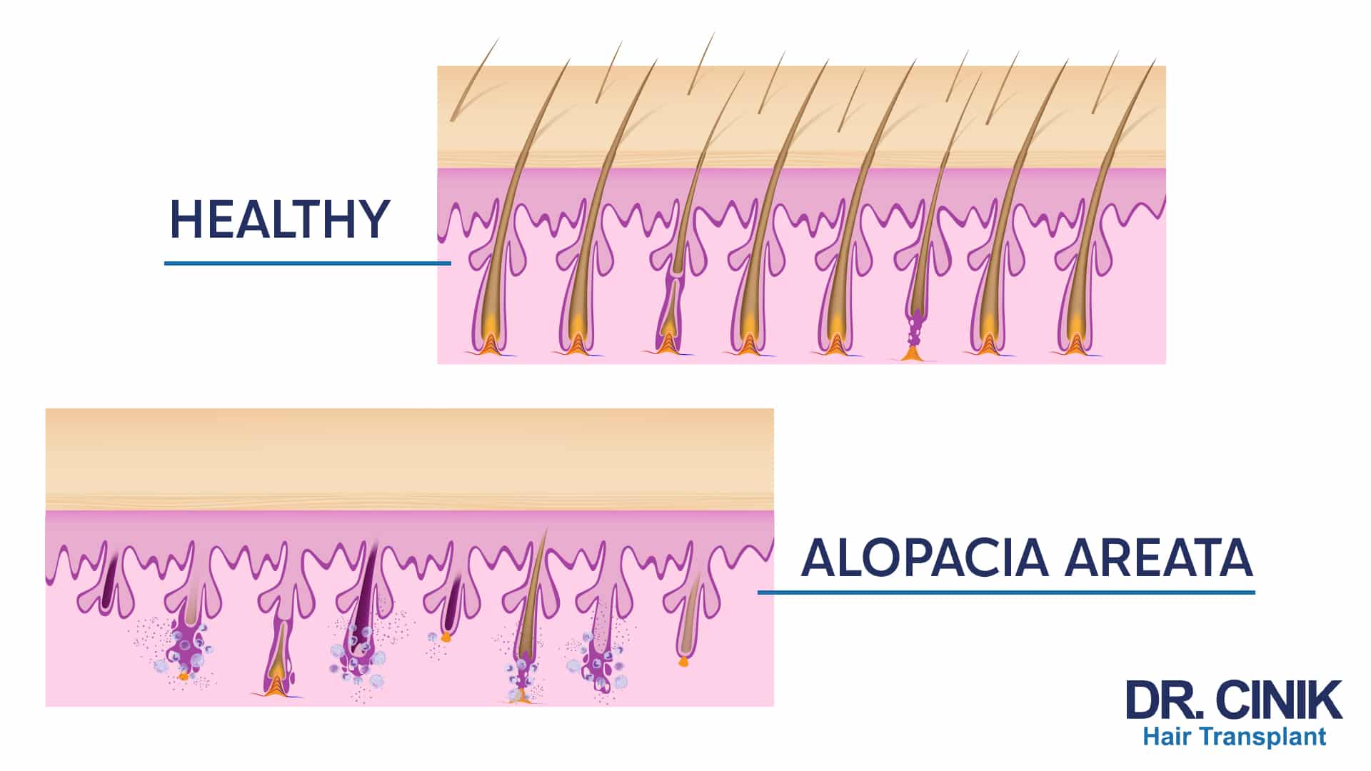 Comparative Diagram: At the top, healthy hair, and at the bottom, hair with alopecia areata.