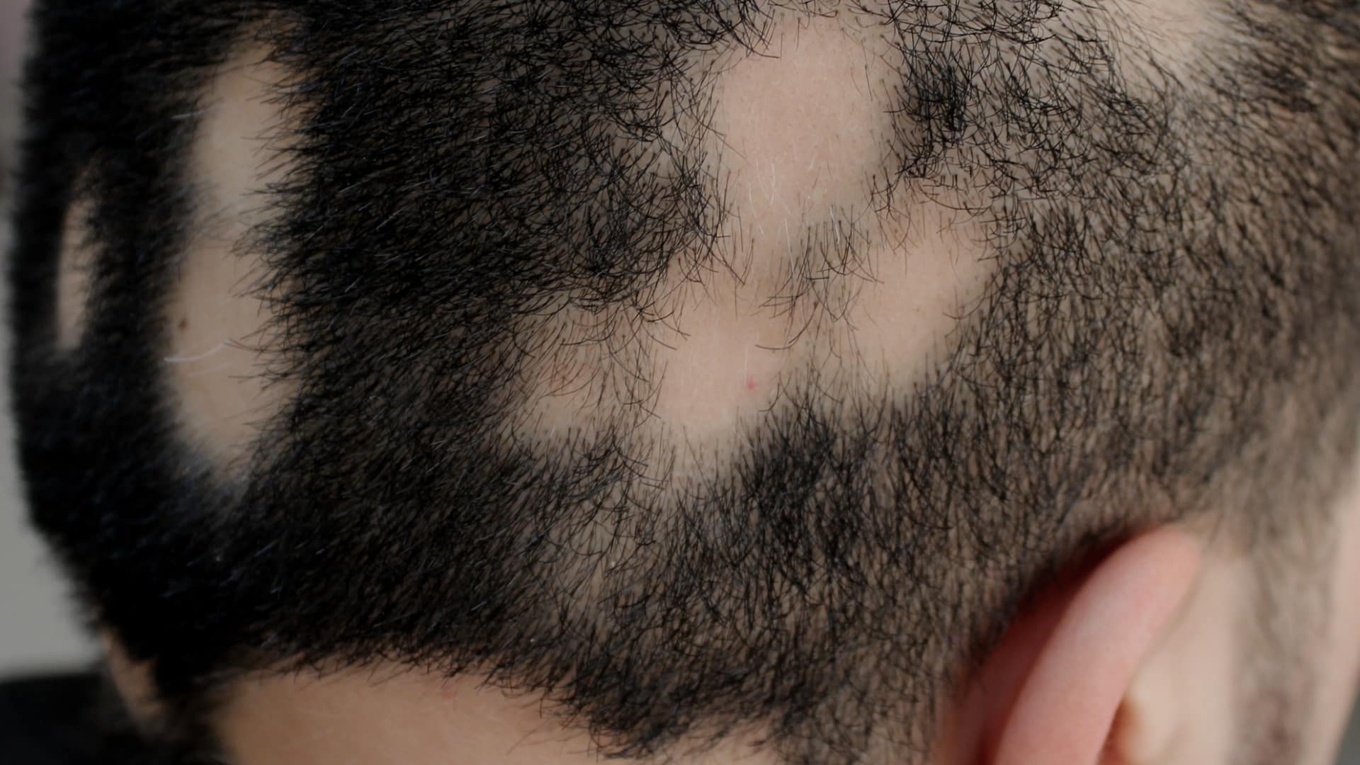 an advanced stage of Alopecia Areata