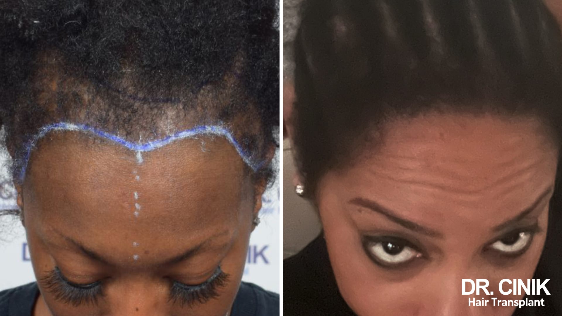 Afro hair transplant for traction alopecia: before and after