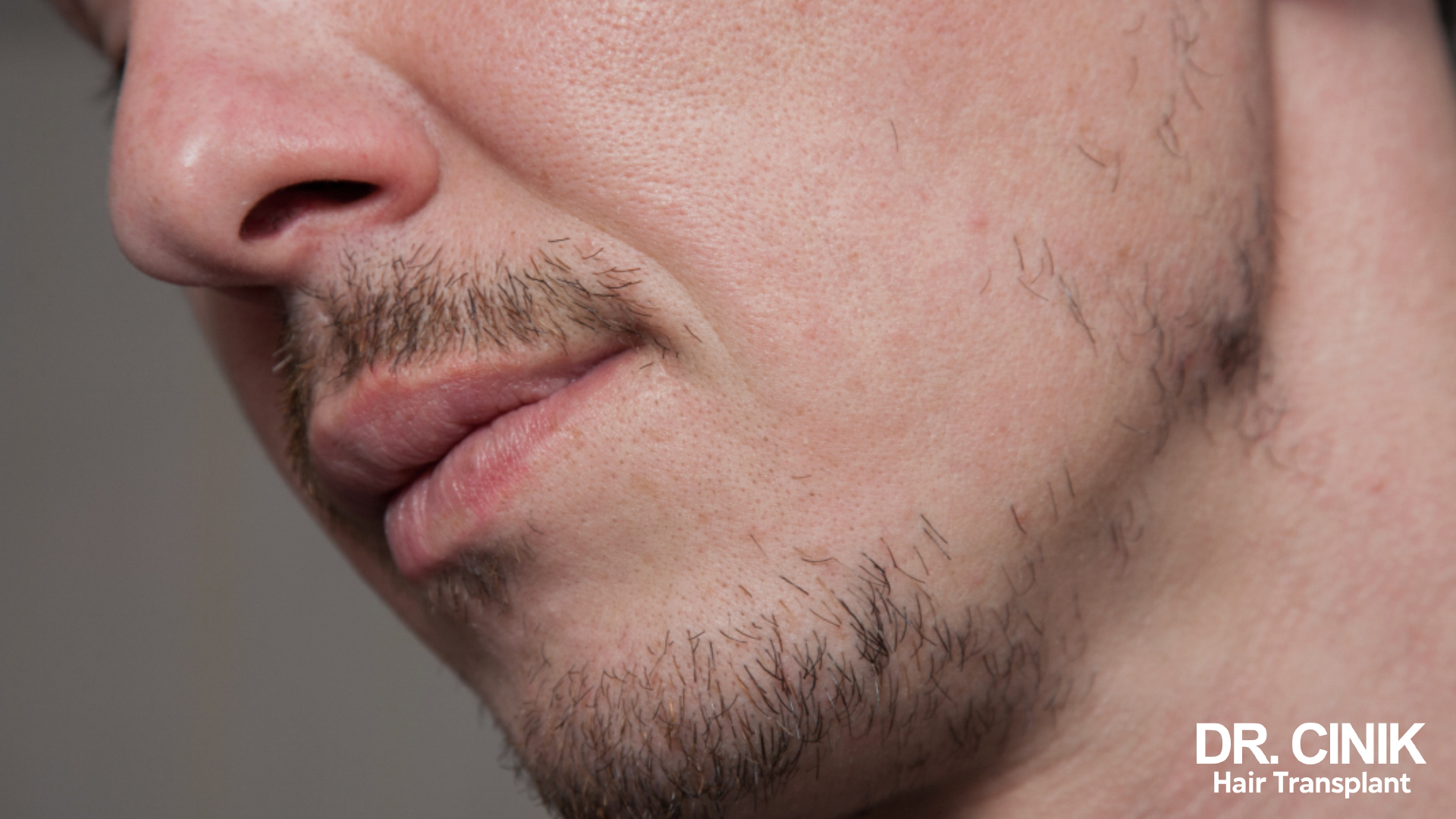 Greffe de barbe : évolution de la repousse mois par mois
