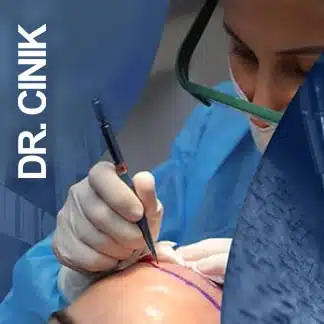 25 FUE Hair Transplant