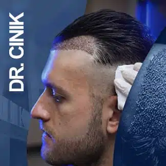 76 No-Shave Hair Transplant