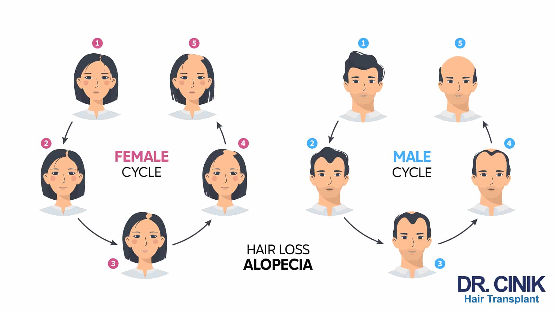İki farklı saç kaybı ilerleyişini beşer aşamada karşılaştıran infografik: kadın döngüsü, alın çizgisini koruyarak tepede açılıyor, erkek döngüsü ise şakak köşelerinden geriye doğru tam kelliğe ilerliyor